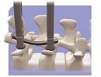 UPASS II minimally invasive spine system