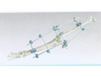 Knee Joint External Fixator