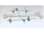 Femur Shaft External Fixator