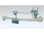 Humeral Shaft External Fixator