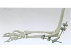 Elbow External Fixator