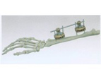 Forearm External Fixator