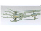 Radius Joint External Fixator