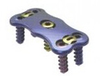 Anterior Cervical Plate I
