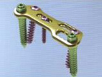 Anterior Thoracolumbar Plate System