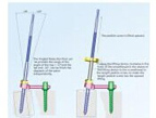 Spinal system-slipping