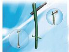 PFNA WG proximal femoral nail anti-spin
