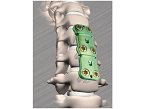 DYNEEPLATE Anterior Cervical Plate System