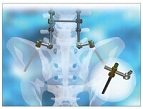 EXILIAC iliac screws