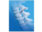 Vertebroplasty