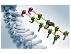 PCF posterior cervical fixation system