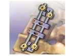 U-FRONT anterior thoracolumbar pedicle screw